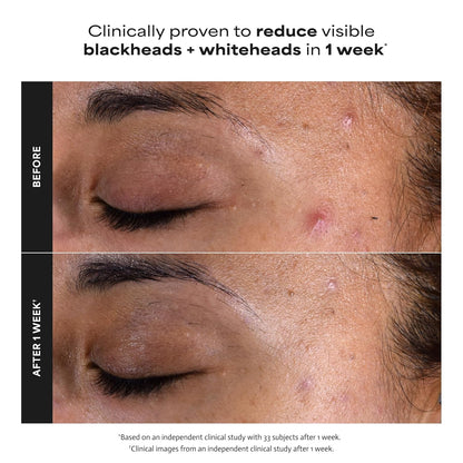 Paula’s Choice 2% BHA Liquid Exfoliant 4 oz | Salicylic Acid